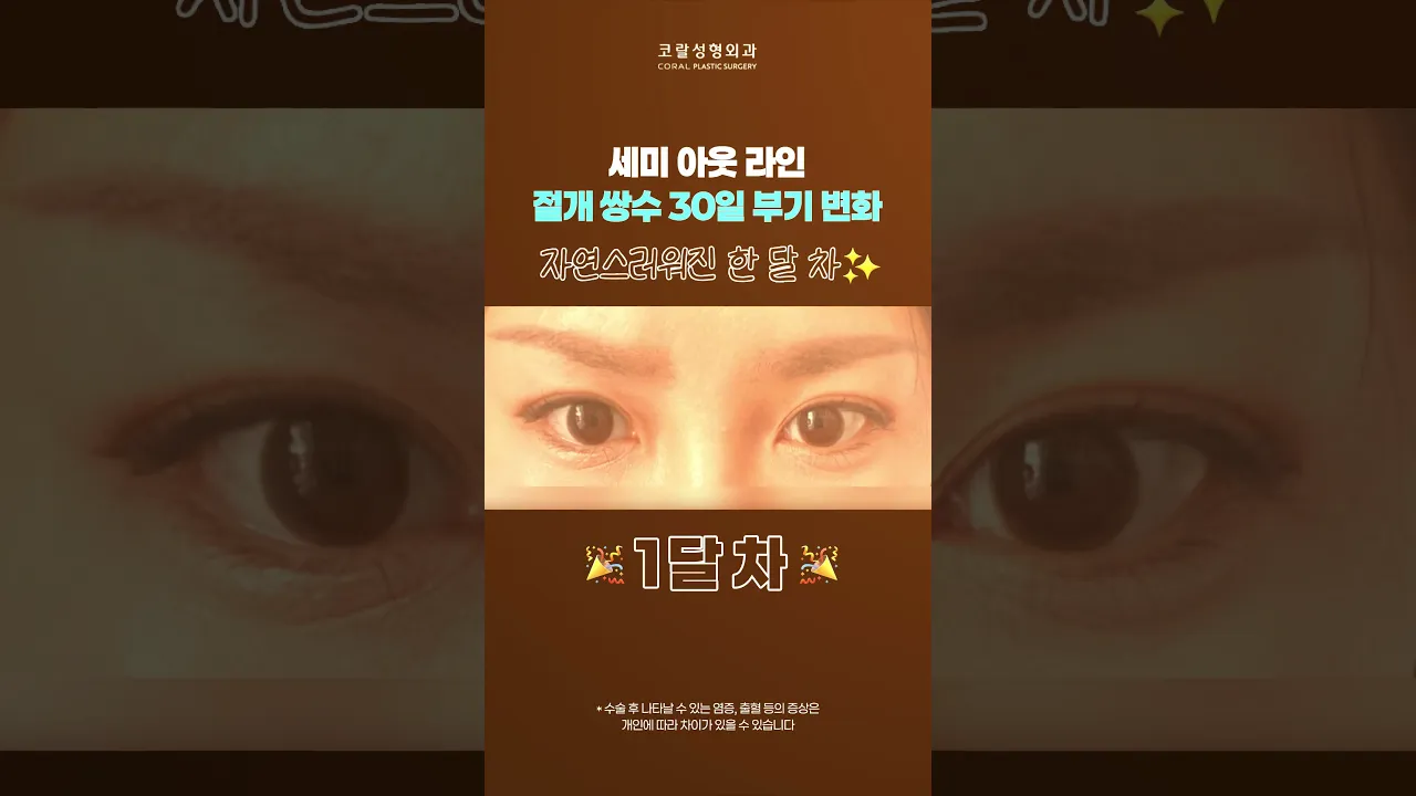 절개 쌍수... 30일 뒤 반전 미쳤다 💥 #shorts