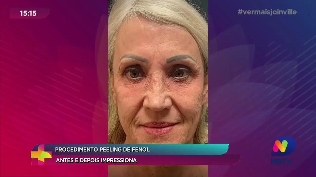 Procedimento Peeling de Fenol: antes e depois impressiona