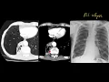 That chest x-ray looks normal why is it in my exam How to approach the unremarkable one