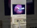 Download Lagu गले में सौंफ फस गई , doctor ने दूरबीन से निकाली । #foreign #body #throat #endoscopy #removal