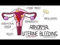 Abnormal Uterine Bleeding AUB - Menorrhagia Heavy Menstrual Bleeding Including Mnemonic