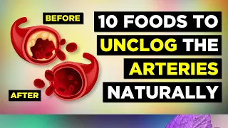 Download 10 Foods That Clean Arteries and Prevent Heart Attacks Naturally MP3