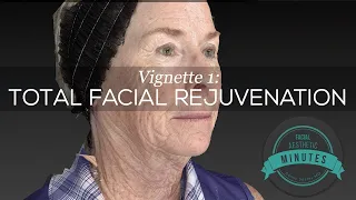 69 yo Female Total Facial Rejuvenation - An Amazing Transformation Aesthetic Minutes