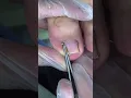 Download Lagu Extreme Toenail Cleaning ASMR | Thick Fungal Nails Removed After Months!