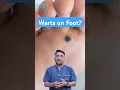 Causes of foot warts Plantar warts