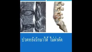 สาเหตุหลักของอาการปวดหลังที่เกิดจากหมอนรองกระดูกคืออะไร และมีปัจจัยใดบ้างที่เร่งการเสื่อมของหมอนรองกระดูก