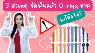  ทำไมวงยางจัดฟันถึงเสื่อมเร็วเกินไป 