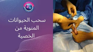 سحب الحيوانات المنوية من الخصية        دندنها