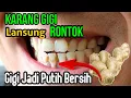 Download Lagu Cara Bersihkan Karang Gigi Sendiri di Rumah || Pemutihan Gigi di Rumah Selama 3 Menit