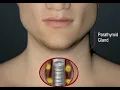 parathyroid surgery