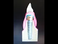 Dentures - Costa Mesa California