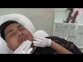 My first PDO threads experience double chin