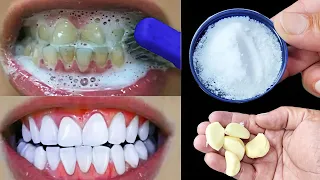 सिर्फ 2 मिनट में गंदे दांतों को मोती की तरह चमका देगा यह घरेलू नुस्खा Teeth Whitening Remedy