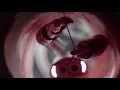 What is the da Vinci SP robotic system