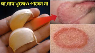 রসুনের সাথে ২ টি উপাদান মিশিয়ে চুলকানিতে লাগালেই ১০ মিনিটে দূর।ঘা,পাঁচড়া ও চুলকানি দূরের উপায়
