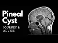 Pineal Cyst Journey Advice
