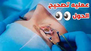 شاهد عمليه تصحيح الحول وعيوب النظر هذا ما لم تراه عينيك من قبل                               دندنها