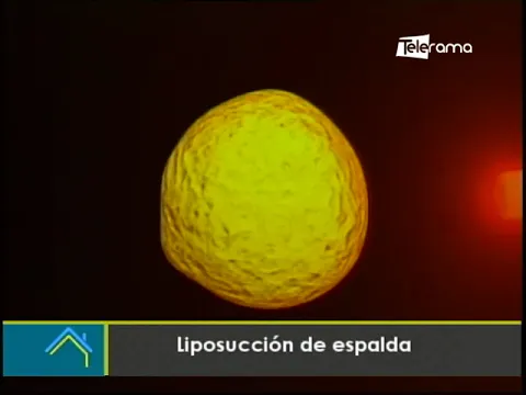 Estética al Día: Liposucción de espalda