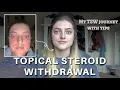 How I healed from TSW and Eczema  - My Topical steroid withdrawal journey with tips and pictures -