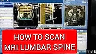 Lumber Spine Mri Scan Protocol Positioning And Planning Live Demo On Canon 1 5 Tesla 