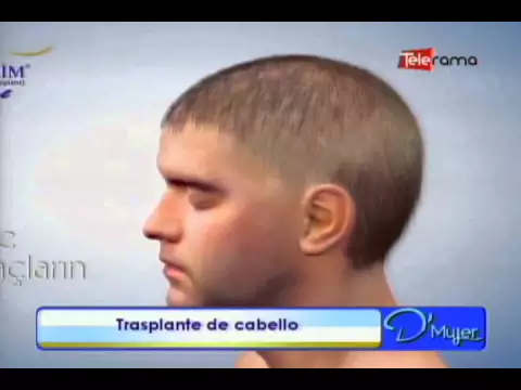 Trasplante de cabello