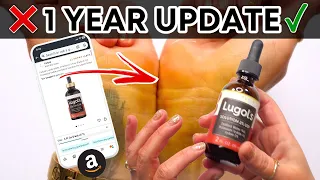 LUGOLS IODINE DROPS 1 Year Later