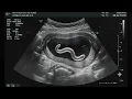 fake bug ultrasound in kid stomach