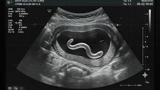 fake bug ultrasound in kid stomach