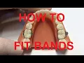 How to fit bands on teeth