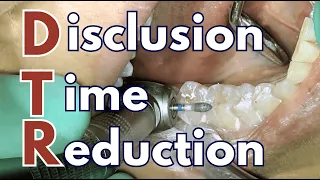 Can Occlusal Adjustment Cure TMD DTR and T-Scan Experience - PDP255