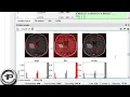 MRI Brain Tumor Detection and Classification Using KNN In PYTHON - Digital Image Processing