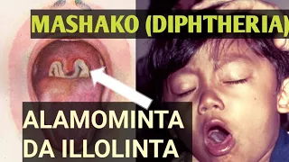 cutar mashako diphtheria alamominta yadda zamu kare kanmu