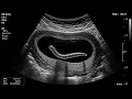 Fake Ultrasound Prank