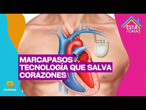 Marcapasos: Tecnología que salva corazones