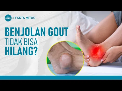 Waspada Benjolan Gout Akibat Asam Urat tak Terkontrol