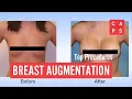 Breast Augmentation FAQs Our World-class Plastic Surgeons Answer Your Questions