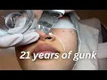 I Got the Most Disgusting Facial in Korea