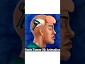 Download Lagu ब्रेन ट्यूमर का ऑपरेशन कैसे किया जाता है ।brain tumor surgery #braintumors #healthtips #gk #shorts