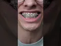 Download Lagu don't eat these 3 things with braces