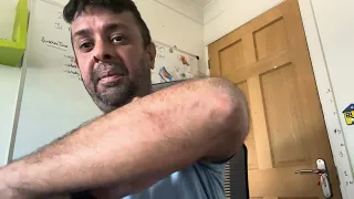 Rinvoq Upadacitinib update Last dose of Adtralza Tralokinumab last week