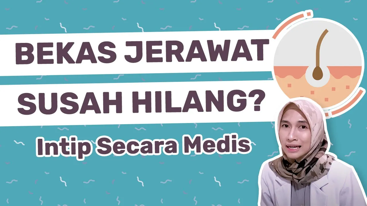 
          
          
          
            
            CARA MENGHILANGKAN BEKAS JERAWAT BOPENG | dr. Vania Utami
          
        . 