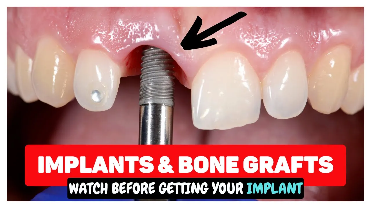 Outline Video Dental Implants & Bone Grafting after Tooth Extractions