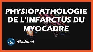 infarctus du myocarde sympt mes et physiopathologie de la crise cardiaque