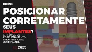 Como obter o posicionamento IDEAL do Implante?