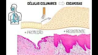 Adaptações celulares - Hipertrofia/Atrofia/Hiperplasia e Metaplasia