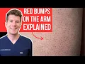 Doctor explains KERATOSIS PILARIS aka chicken skin Causes treatments and AT HOME MANAGEMENT
