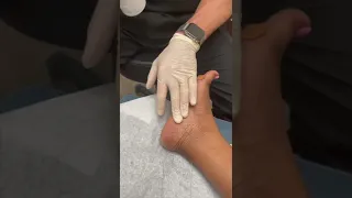 Cortisone Injection For Heel Pain Plantar Fasciitis  Cortisone Injection For Heel Pain Plantar Fasciitis