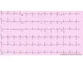 Stepwise Interpretation 4 Ectopic Atrial Rhythm