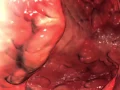 Download Lagu Ulcerative Colitis: Learn@Visible Body