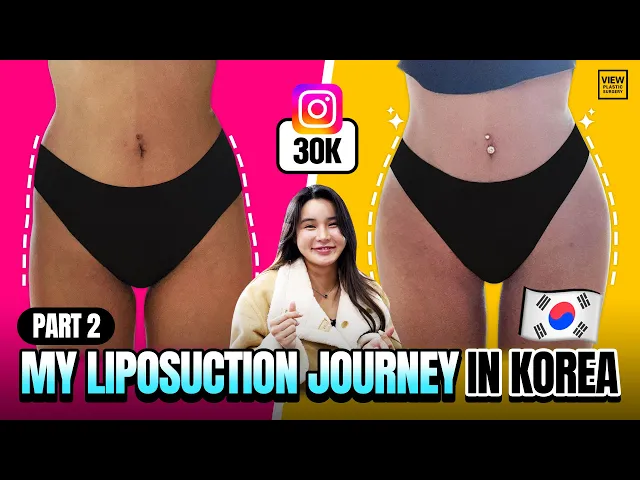 My Liposuction Journey in Korea Vlog (Part 2)